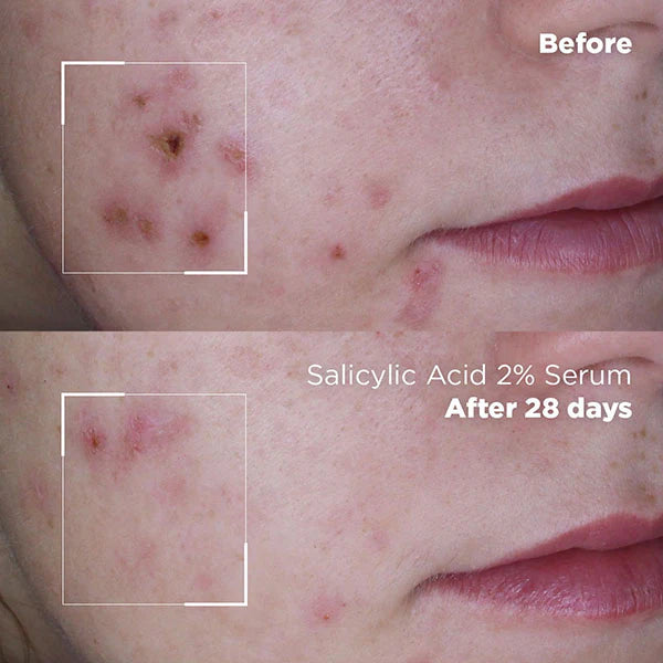 Skin Republic Salicylsäure 2% Serum 30ml